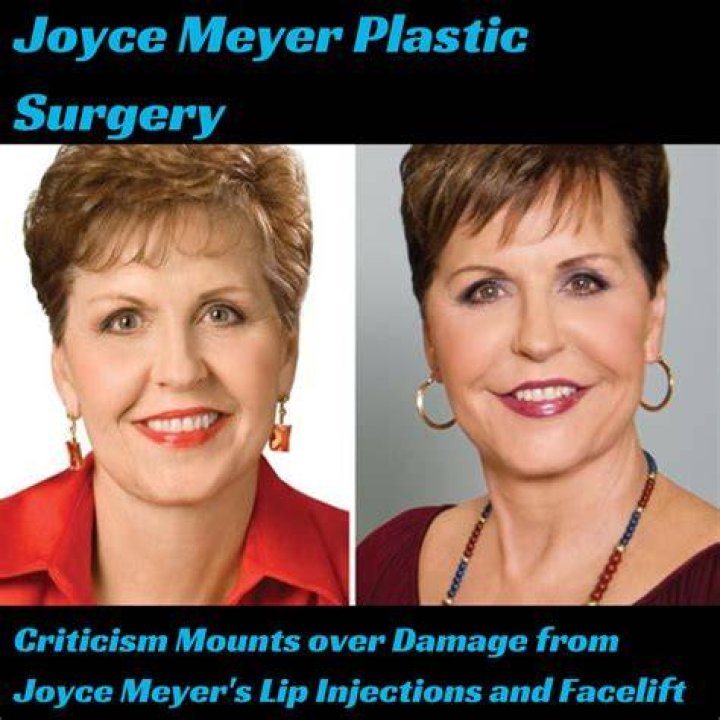 Unveiling The Truths Behind Joyce Meyer's Plastic Surgery Journey